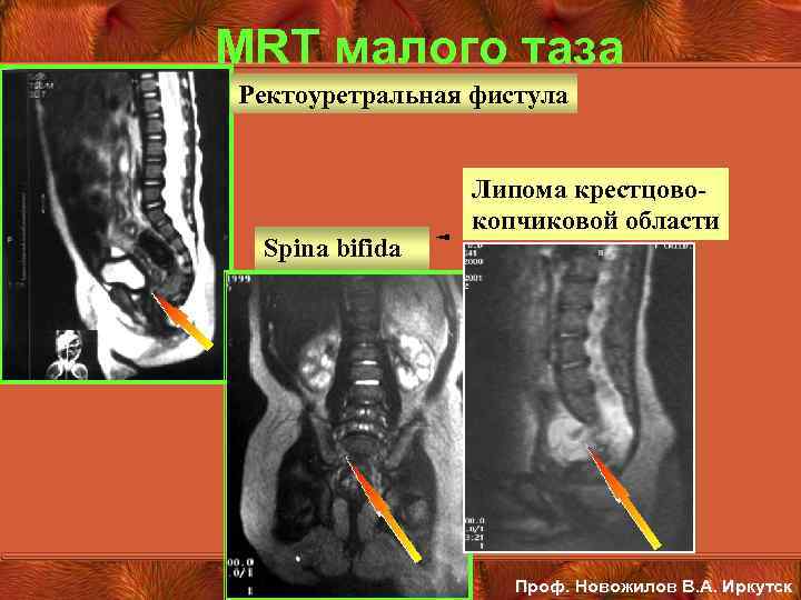 MRT малого таза Ректоуретральная фистула Spina bifida Липома крестцовокопчиковой области Проф. Новожилов В. А.