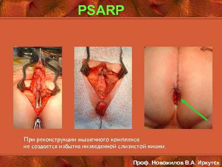 PSARP При реконструкции мышечного комплекса не создается избытка низведенной слизистой кишки. . Проф. Новожилов