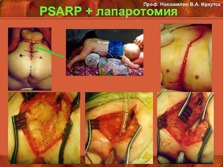 Проф. Новожилов В. А. Иркутск PSARP + лапаротомия 