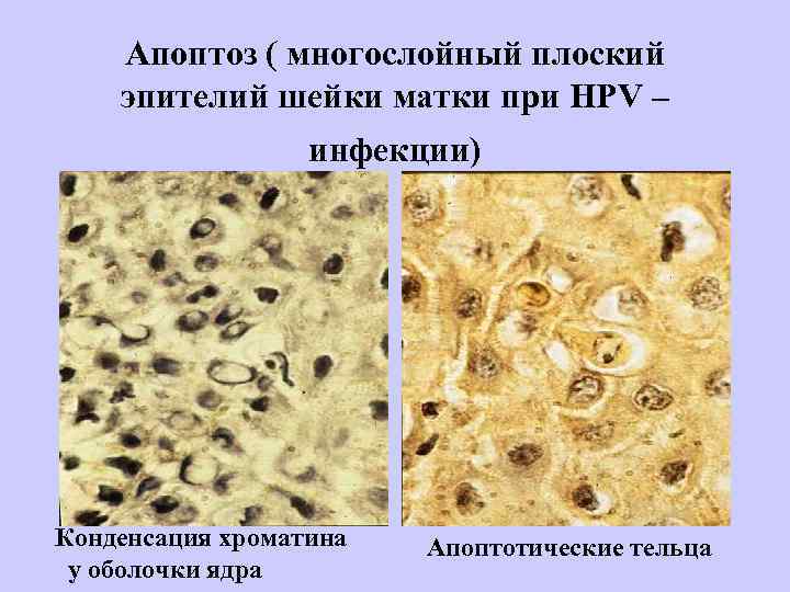 Апоптоз ( многослойный плоский эпителий шейки матки при НРV – инфекции) Конденсация хроматина у