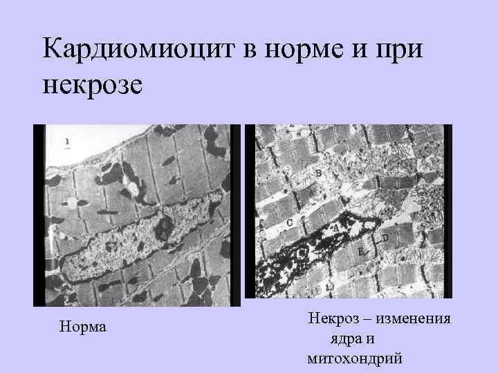 Кардиомиоцит в норме и при некрозе Норма Некроз – изменения ядра и митохондрий 