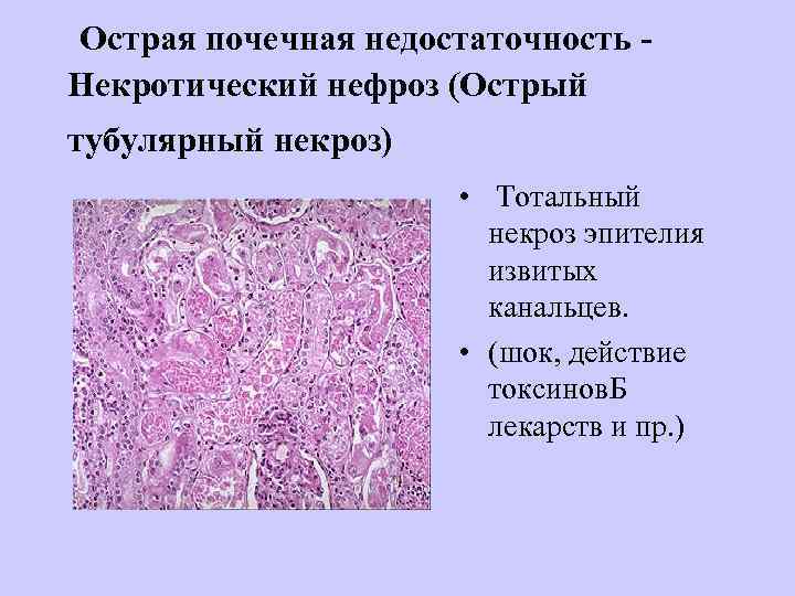  Острая почечная недостаточность - Некротический нефроз (Острый тубулярный некроз) • Тотальный некроз эпителия