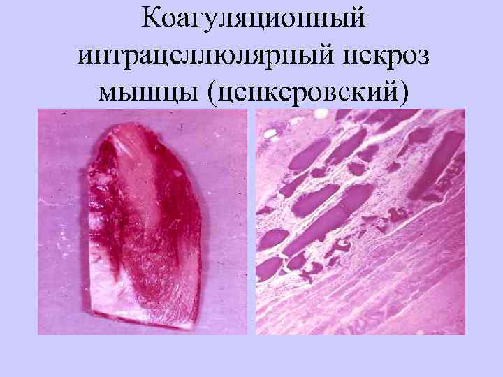 Коагуляционный интрацеллюлярный некроз мышцы (ценкеровский) 