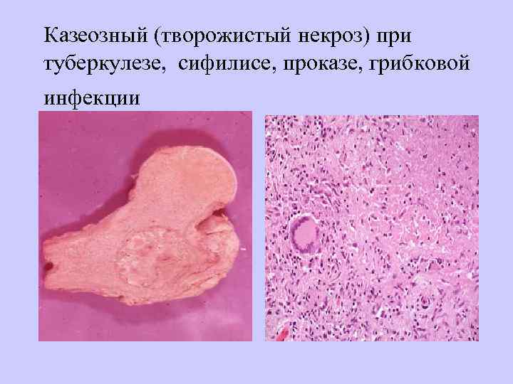 Казеозный (творожистый некроз) при туберкулезе, сифилисе, проказе, грибковой инфекции 