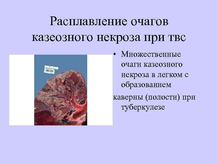 Расплавление очагов казеозного некроза при твс • Множественные очаги казеозного некроза в легком с