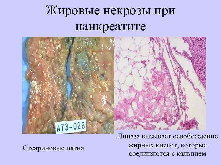 Жировые некрозы при панкреатите Стеариновые пятна Липаза вызывает освобождение жирных кислот, которые соединяются с