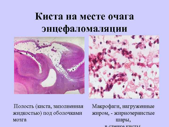 Киста на месте очага энцефаломаляции Полость (киста, заполненная жидкостью) под оболочками мозга Макрофаги, нагруженные
