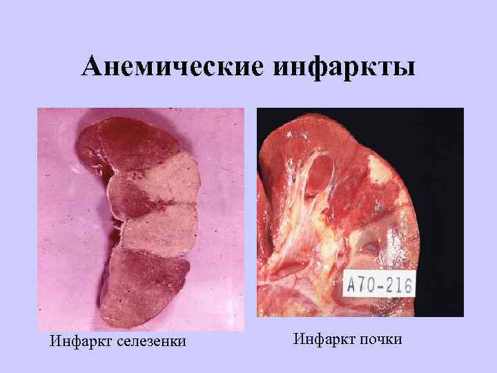 Анемические инфаркты Инфаркт селезенки Инфаркт почки 