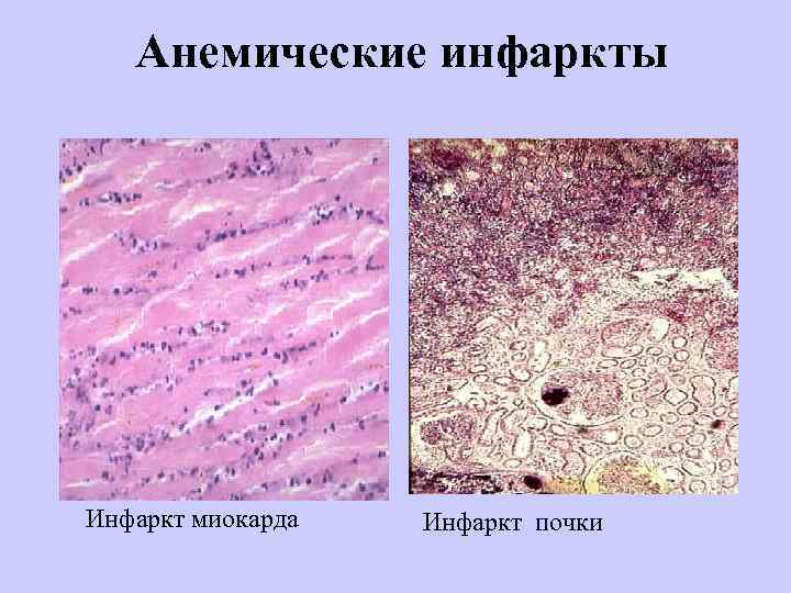 Анемические инфаркты Инфаркт миокарда Инфаркт почки 