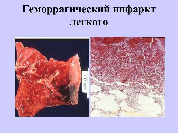 Геморрагический инфаркт легкого 