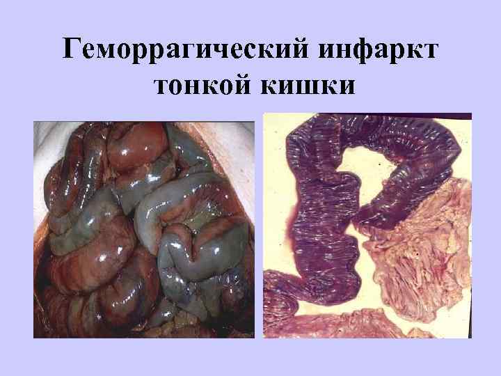 Геморрагический инфаркт тонкой кишки 