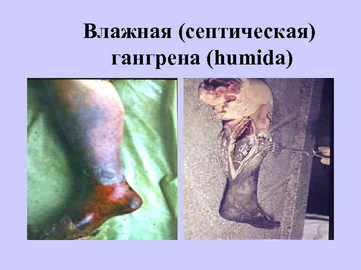  Влажная (септическая) гангрена (humida) 
