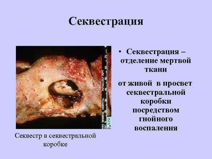 Секвестрация • Секвестрация – отделение мертвой ткани Секвестр в секвестральной коробке от живой в