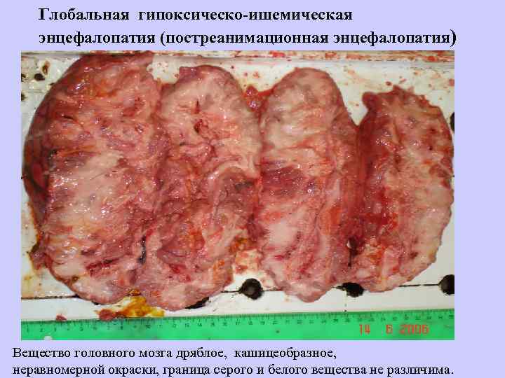 Глобальная гипоксическо-ишемическая энцефалопатия (постреанимационная энцефалопатия) Вещество головного мозга дряблое, кашицеобразное, неравномерной окраски, граница серого