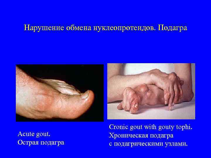 Нарушение обмена нуклеопротеидов. Подагра Аcute gout. Острая подагра Сronic gout with gouty tophi. Хроническая