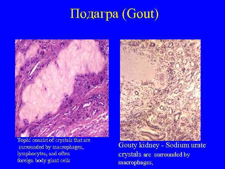 Подагра (Gout) Тophi consist of crystals that are surrounded by macrophages, lymphocytes, and often