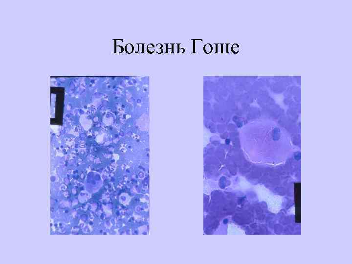 Болезнь Гоше 