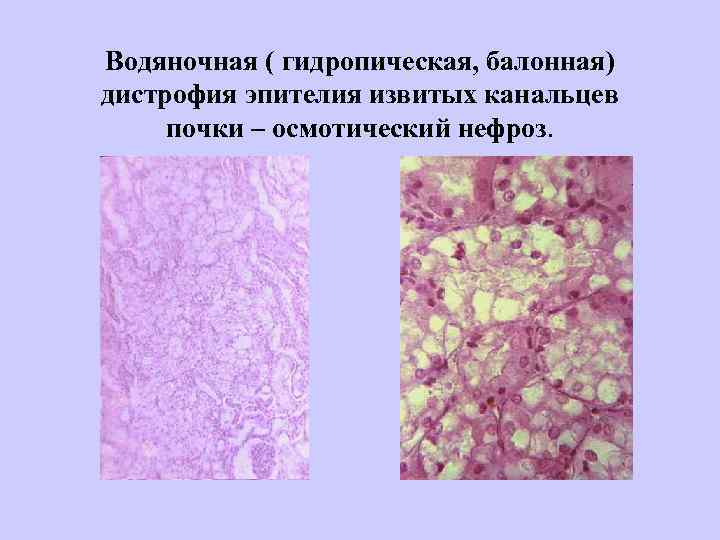 Водяночная ( гидропическая, балонная) дистрофия эпителия извитых канальцев почки – осмотический нефроз. 
