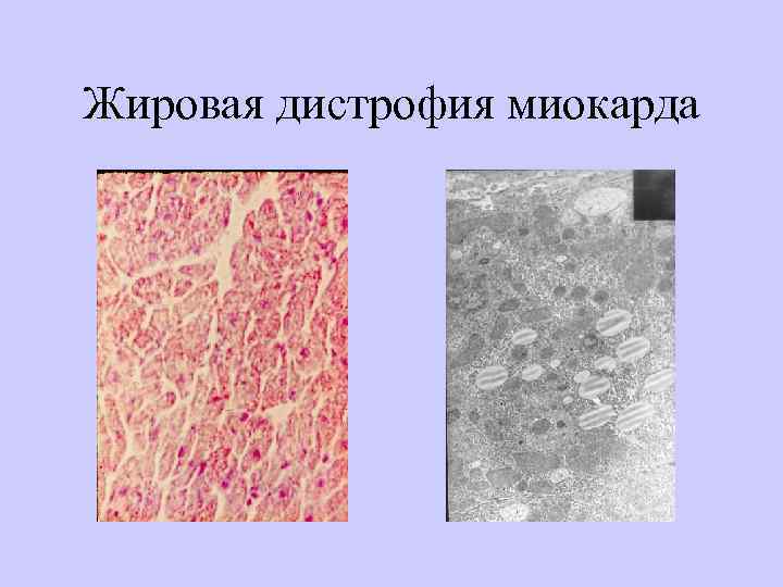 Жировая дистрофия миокарда 