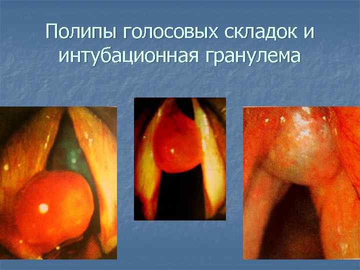 Полипы голосовых складок и интубационная гранулема 