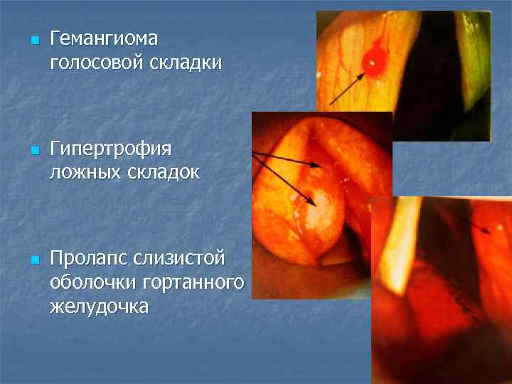 n n n Гемангиома голосовой складки Гипертрофия ложных складок Пролапс слизистой оболочки гортанного желудочка