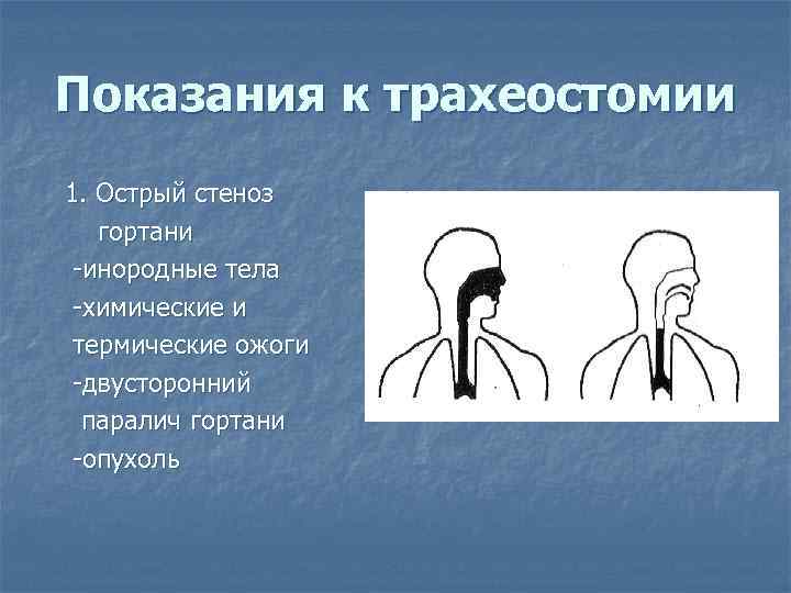 Показания к трахеостомии 1. Острый стеноз гортани -инородные тела -химические и термические ожоги -двусторонний