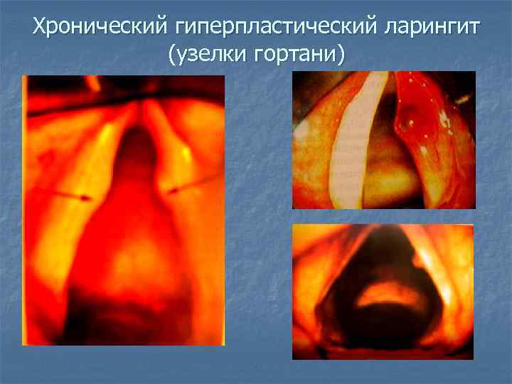 Хронический гиперпластический ларингит (узелки гортани) 