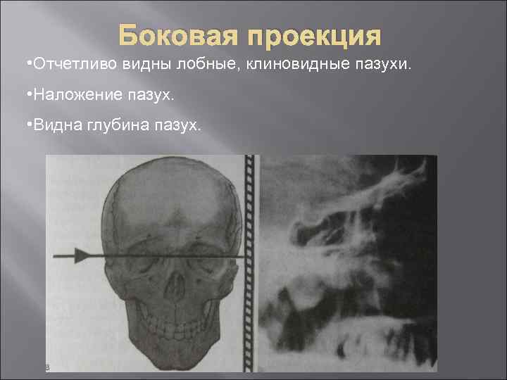 Боковая проекция • Отчетливо видны лобные, клиновидные пазухи. • Наложение пазух. • Видна глубина