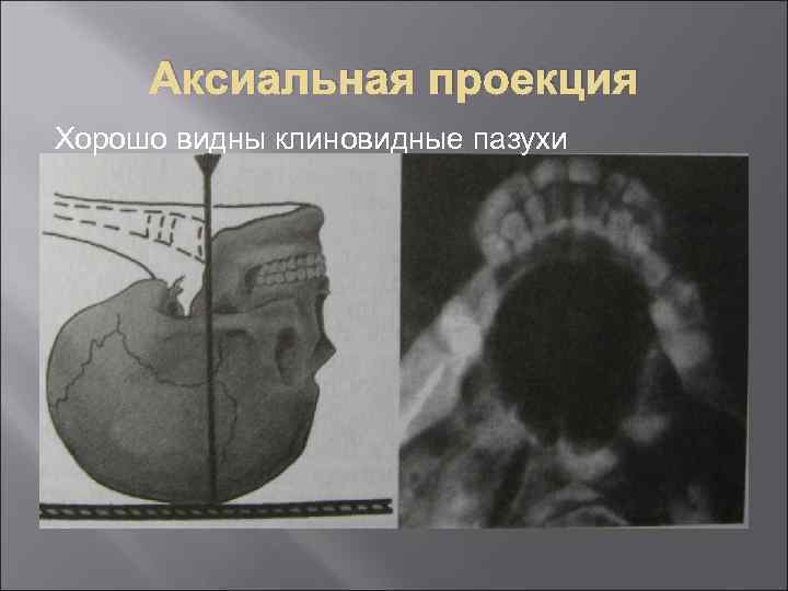 Аксиальная проекция Хорошо видны клиновидные пазухи 