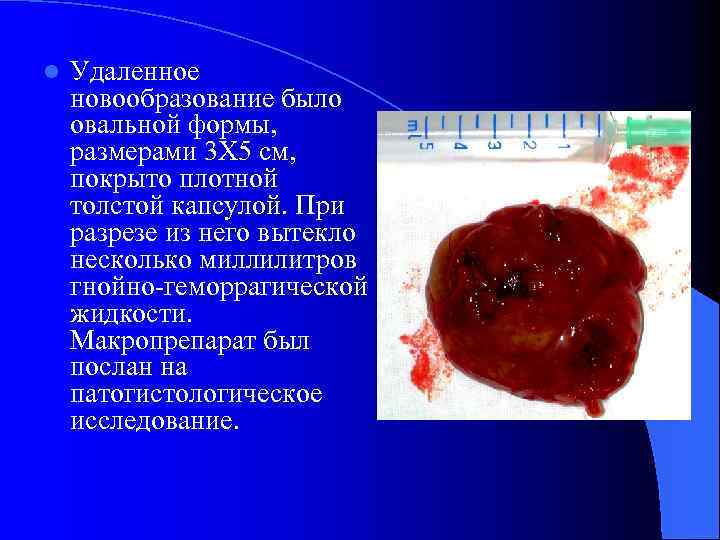 l Удаленное новообразование было овальной формы, размерами 3 Х 5 см, покрыто плотной толстой