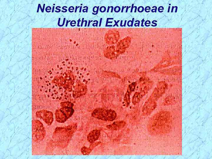 Neisseria gonorrhoeae in Urethral Exudates 