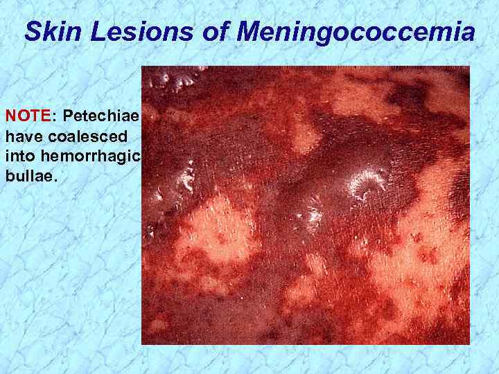 Skin Lesions of Meningococcemia NOTE: Petechiae have coalesced into hemorrhagic bullae. 