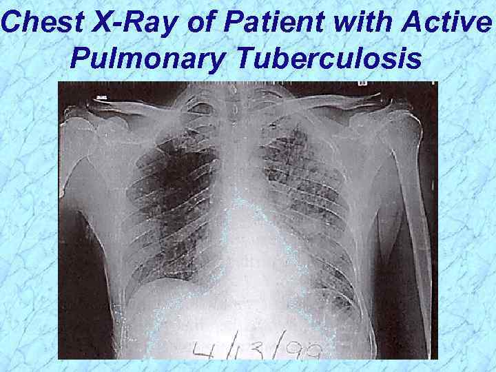 Chest X-Ray of Patient with Active Pulmonary Tuberculosis 