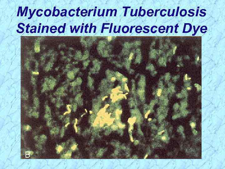 Mycobacterium Tuberculosis Stained with Fluorescent Dye 