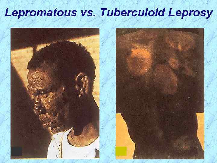 Lepromatous vs. Tuberculoid Leprosy 