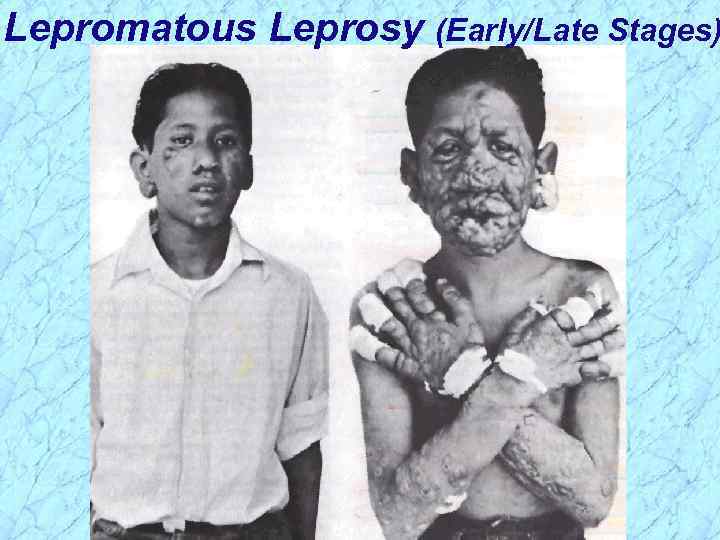 Lepromatous Leprosy (Early/Late Stages) 