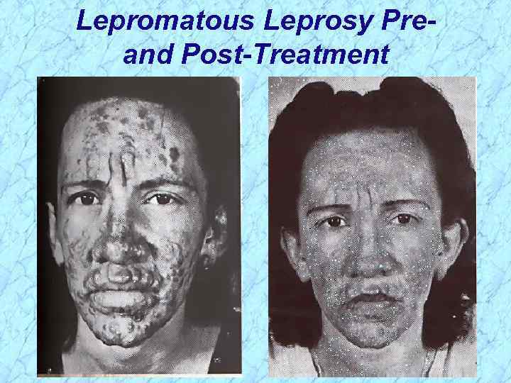 Lepromatous Leprosy Preand Post-Treatment 