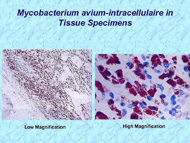 Mycobacterium avium-intracellulaire in Tissue Specimens Low Magnification High Magnification 