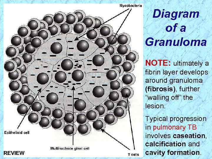 Diagram of a Granuloma NOTE: ultimately a fibrin layer develops around granuloma (fibrosis), further