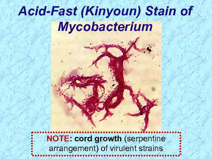 Acid-Fast (Kinyoun) Stain of Mycobacterium NOTE: cord growth (serpentine arrangement) of virulent strains 