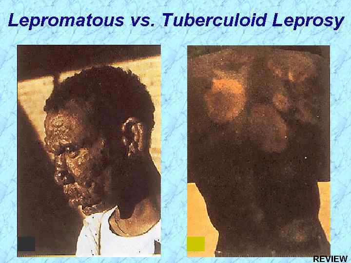 Lepromatous vs. Tuberculoid Leprosy REVIEW 