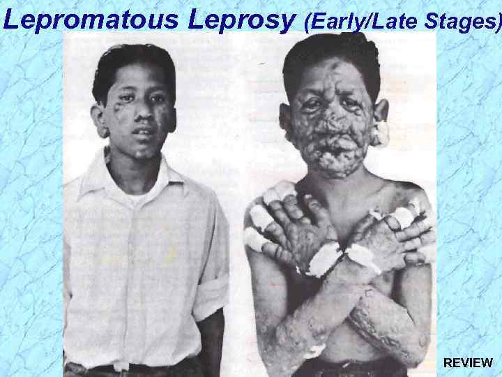 Lepromatous Leprosy (Early/Late Stages) REVIEW 