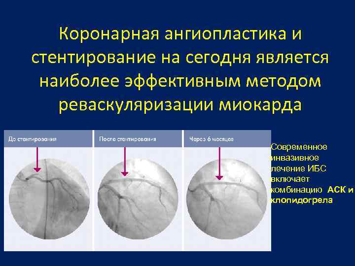 Коронарная ангиопластика и стентирование на сегодня является наиболее эффективным методом реваскуляризации миокарда Современное инвазивное