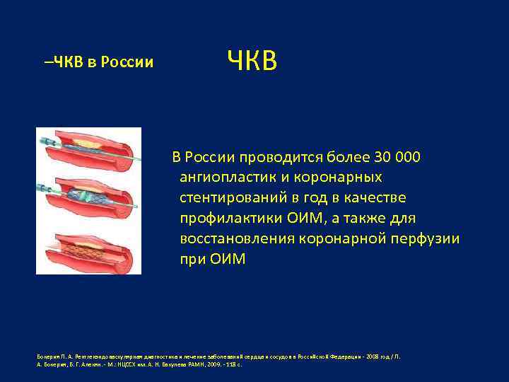 –ЧКВ в России ЧКВ В России проводится более 30 000 ангиопластик и коронарных стентирований