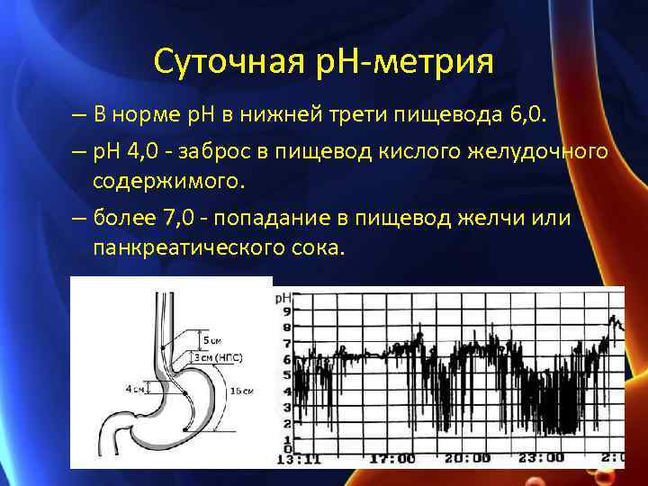 Суточная p. H-метрия – В норме р. Н в нижней трети пищевода 6, 0.