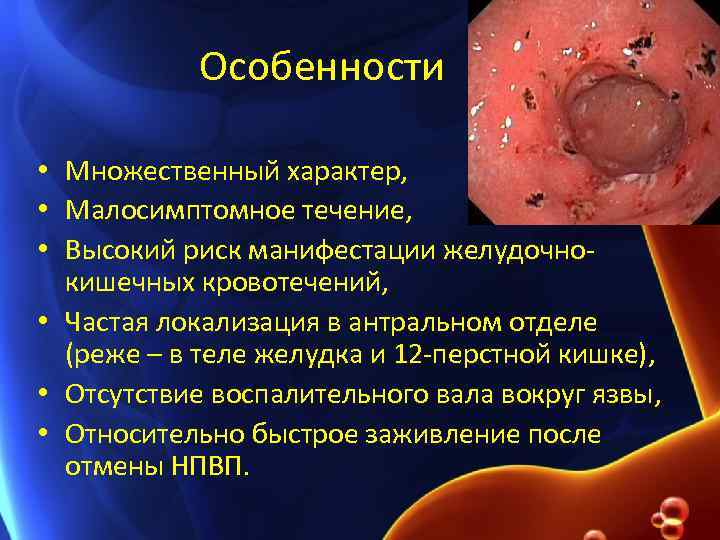 Особенности • Множественный характер, • Малосимптомное течение, • Высокий риск манифестации желудочнокишечных кровотечений, •