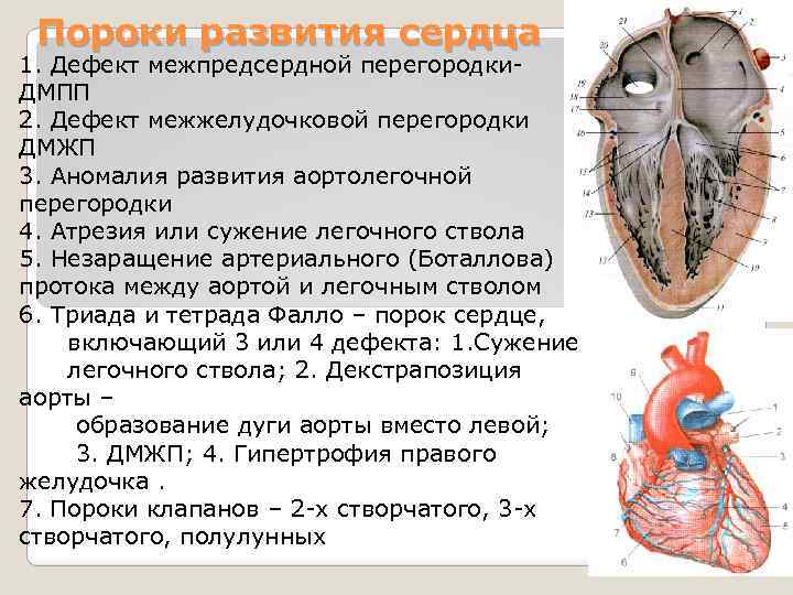 Пороки развития сердца 1. Дефект межпредсердной перегородки. ДМПП 2. Дефект межжелудочковой перегородки ДМЖП 3.