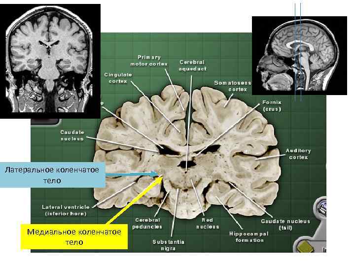 Латеральное коленчатое тело Медиальное коленчатое тело 