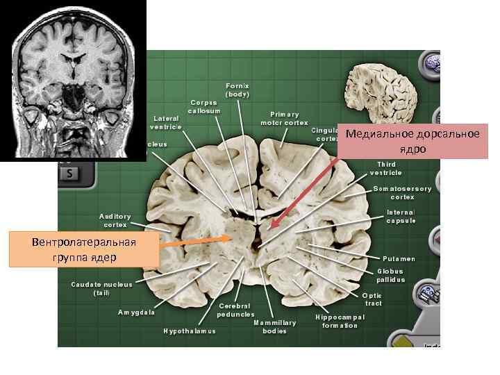Медиальное дорсальное ядро Вентролатеральная группа ядер 
