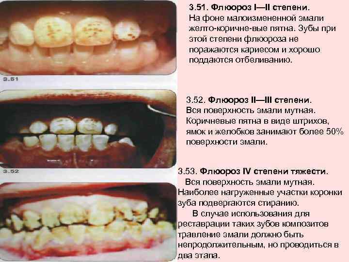 3. 51. Флюороз I—II степени. На фоне малоизмененной эмали желто коричне вые пятна. Зубы